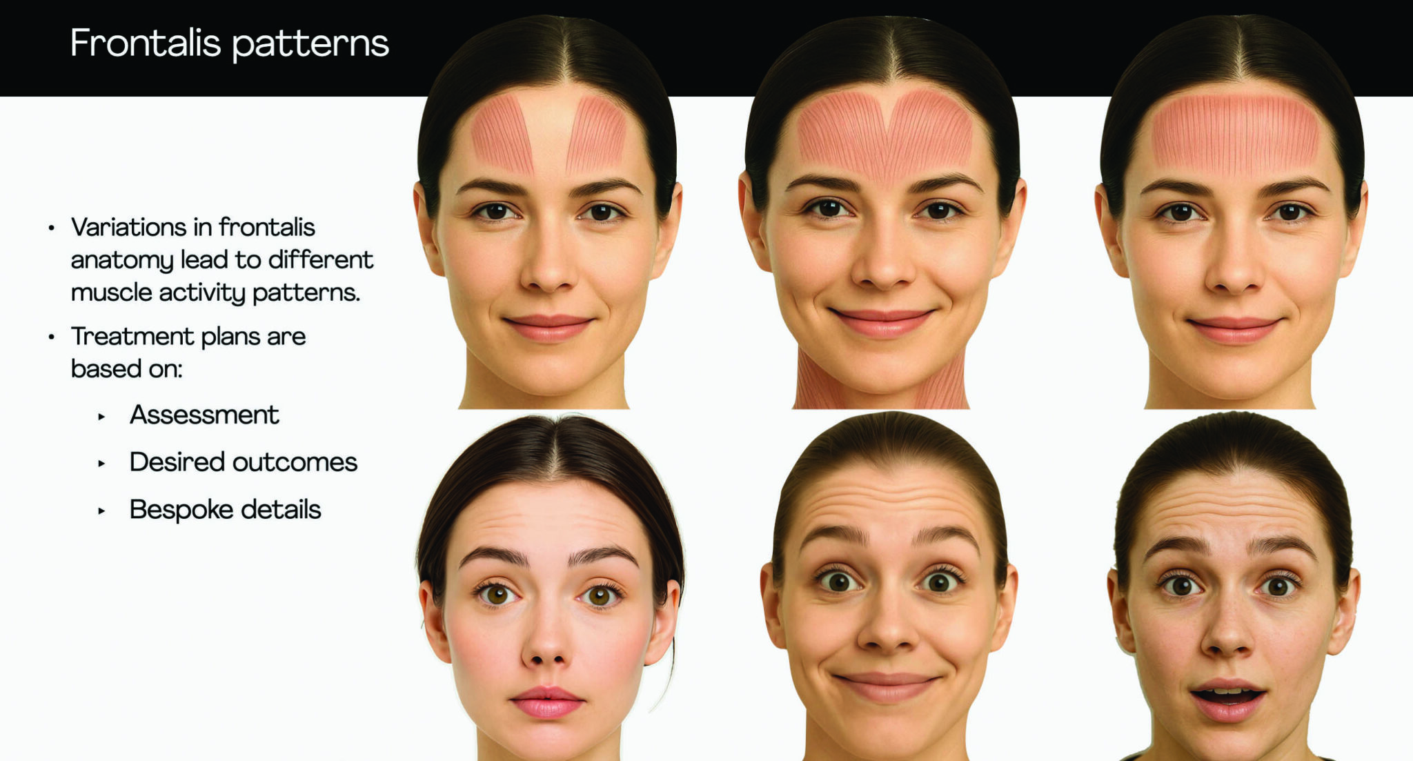 Forehead Rhytid Patterns Treating the forehead with botulinum toxin: key challenges - Aesthetic ...