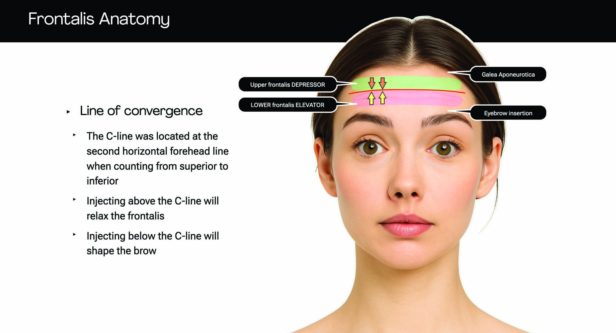 Spocking Botox Treating the forehead with botulinum toxin: key challenges - Aesthetic ...